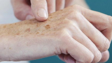Resultado de imagem para Campanha contra câncer de pele é estendida até o fim do verão